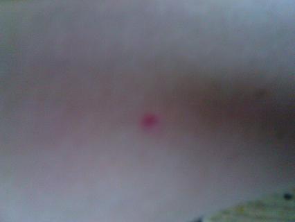 Červena tečka na ruce