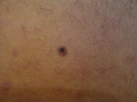 Melanom?