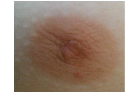 Výrastok pri bradavke