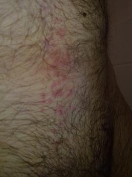 Vyrážky na tele po styku